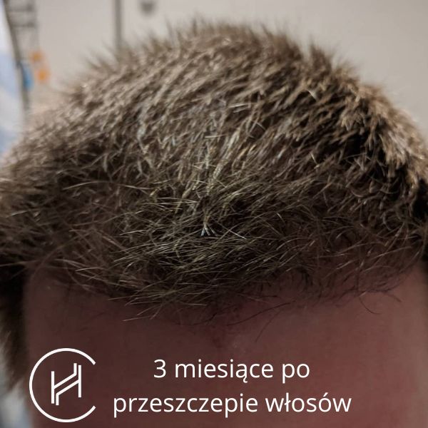 przeszczep włosów po jakim czasie normalny szampon
