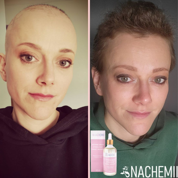 jaka odżywka do włosów po chemioterapii