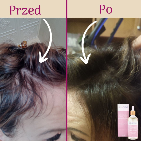 szampon na porost włosów po chemioterapii