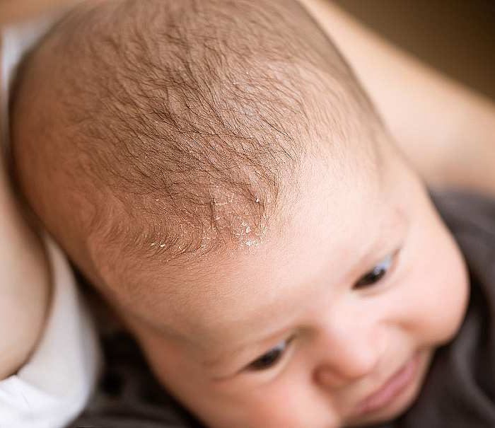łuszczaca się skóra głowy dziecka szampon